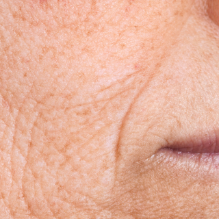 Anti Aging