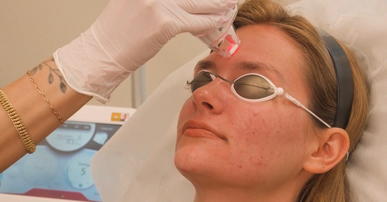 Complexion-Laser-crop-1