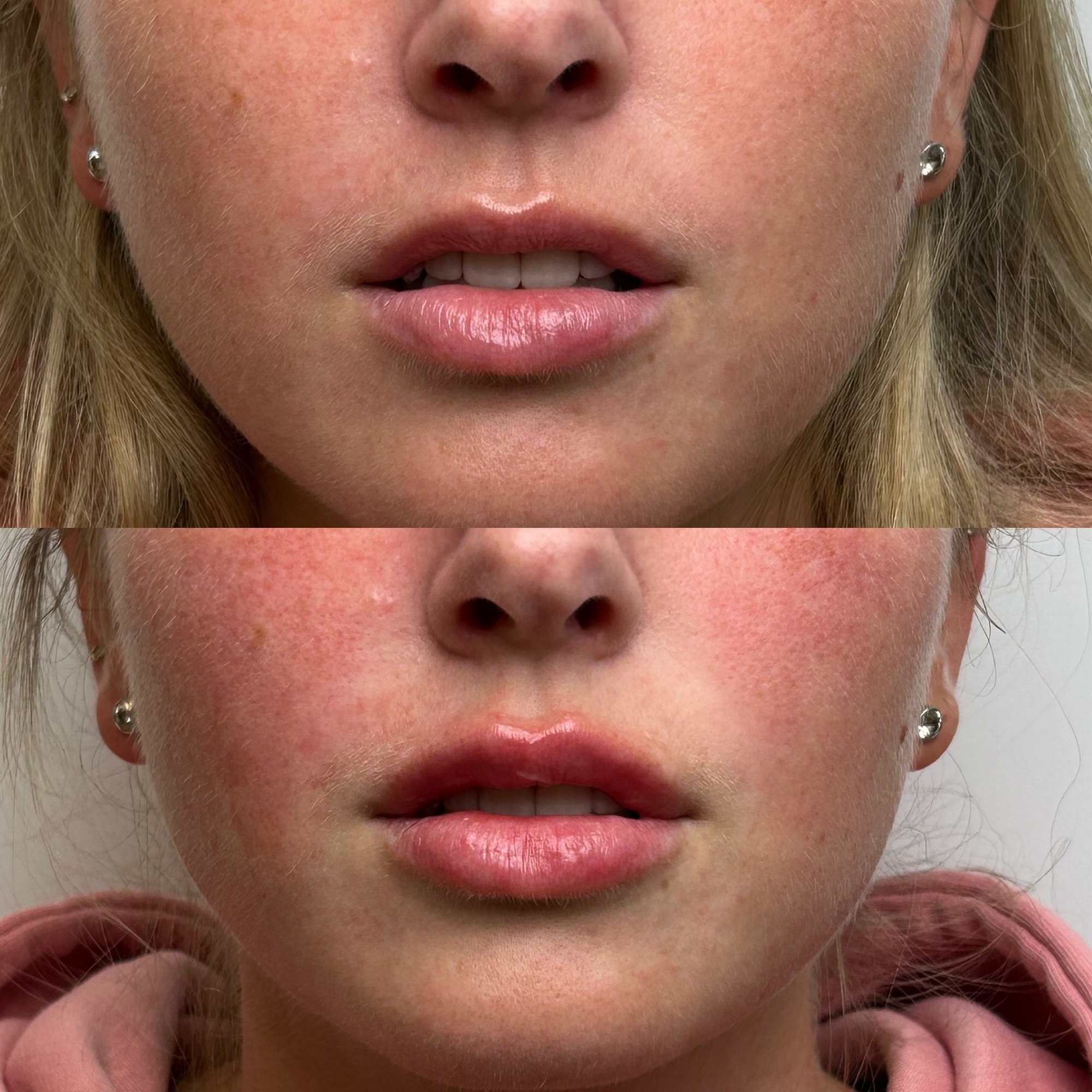 Lip filler