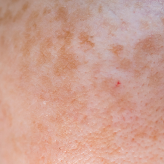 Pigmentation