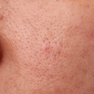 Pore Care