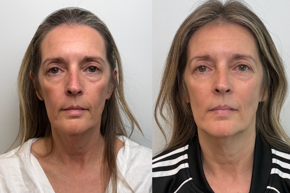 xerf-before-and-after-results